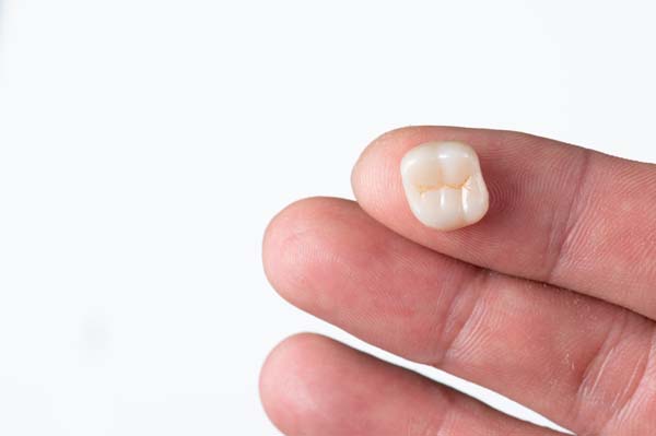 FAQs About CEREC® Crowns