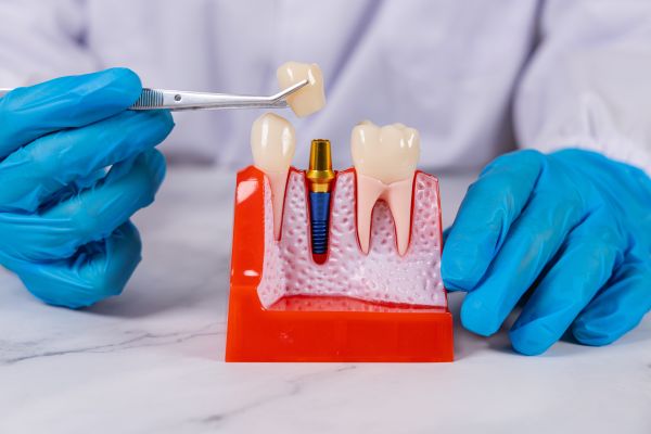 Signs It Is Time To Replace A Dental Implant Restoration