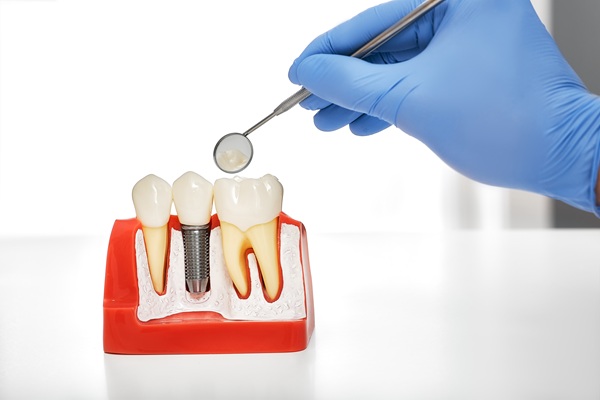 Bone And Gum Grafting Before Dental Implant Placement