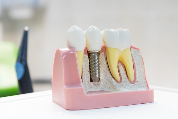 A Step By Step Guide To Implant Restoration