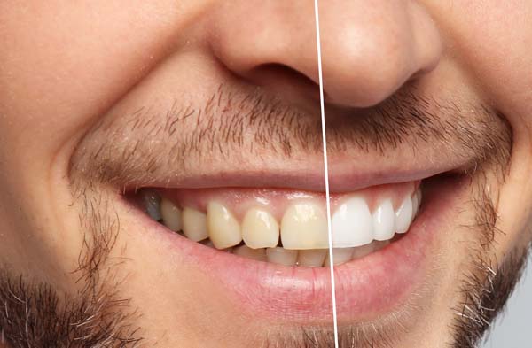 Is Professional Teeth Whitening And Teeth Bleaching The Same?